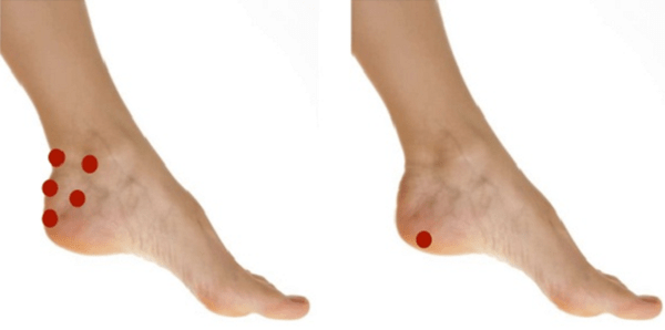 Đau gót chân trái là bệnh gì?