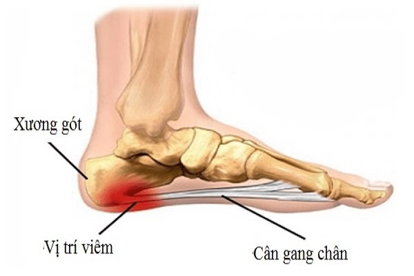 Tại sao đau gót chân trái?